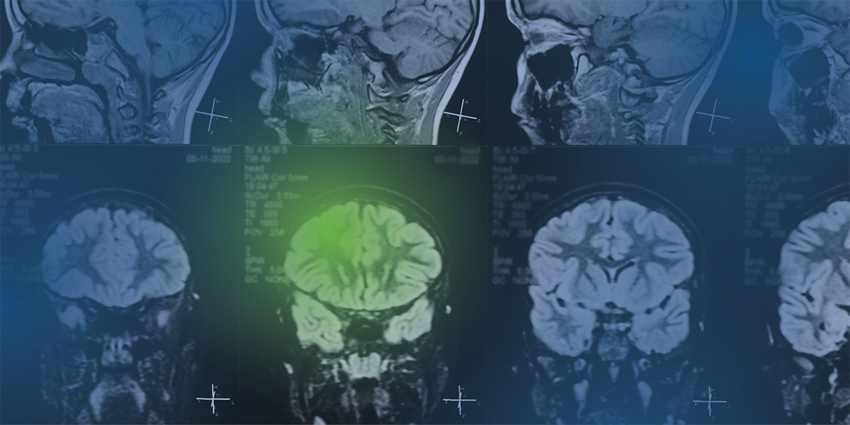 a brain scan image with multiple scans and one highlighted scan